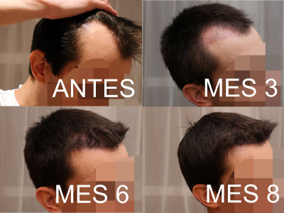 DERECHA 3 6 8 meses