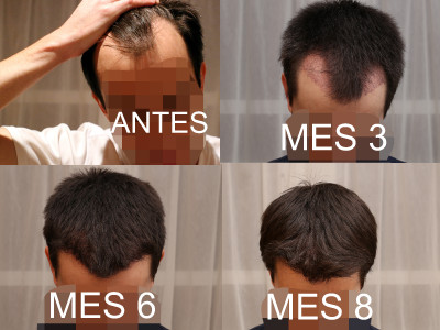 FRONTAL 3 6 8 meses